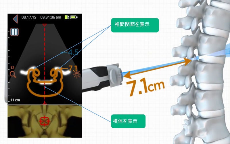 疼痛管理（局所麻酔） - B. Braun