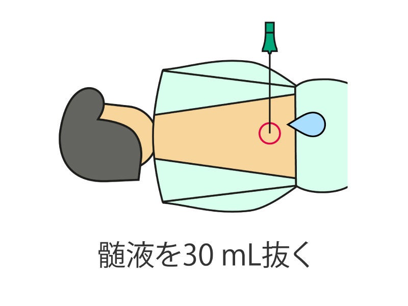 水頭症のひと 水頭症の検査方法と治療法 - B. Braun