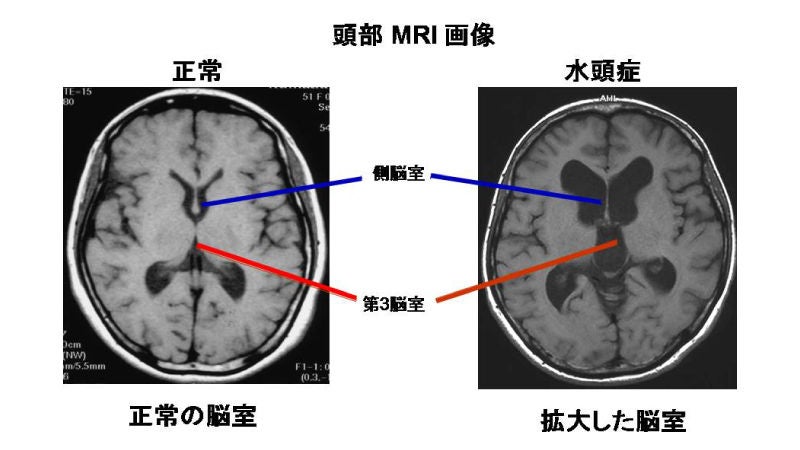 水頭症のひと 水頭症の特徴と症状 - B. Braun