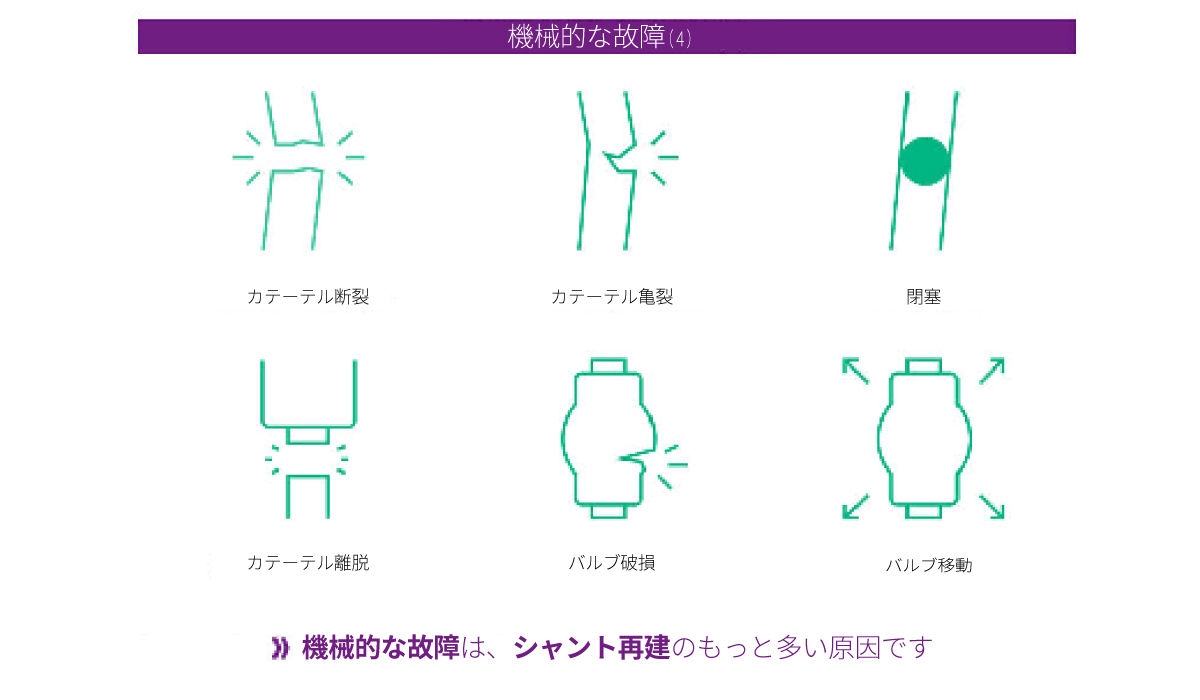 水頭症シャントの機械的故障の情報グラフ