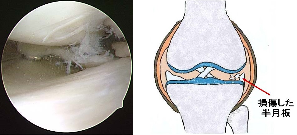 膝関節の疾患と治療法 その2