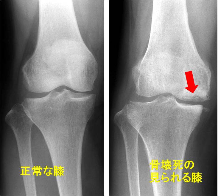 膝関節の疾患と治療法 その2